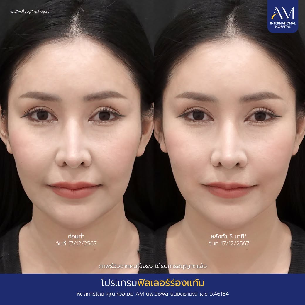 รีวิว ฟิลเลอร์ร่องแก้ม