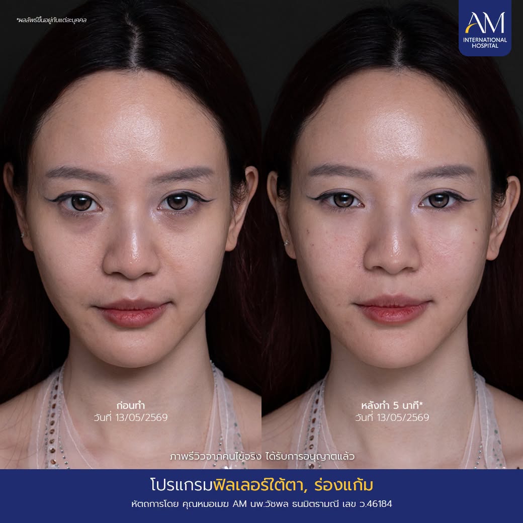 รีวิว ฟิลเลอร์ใต้ตา + ฟิลเลอร์ร่องแก้ม