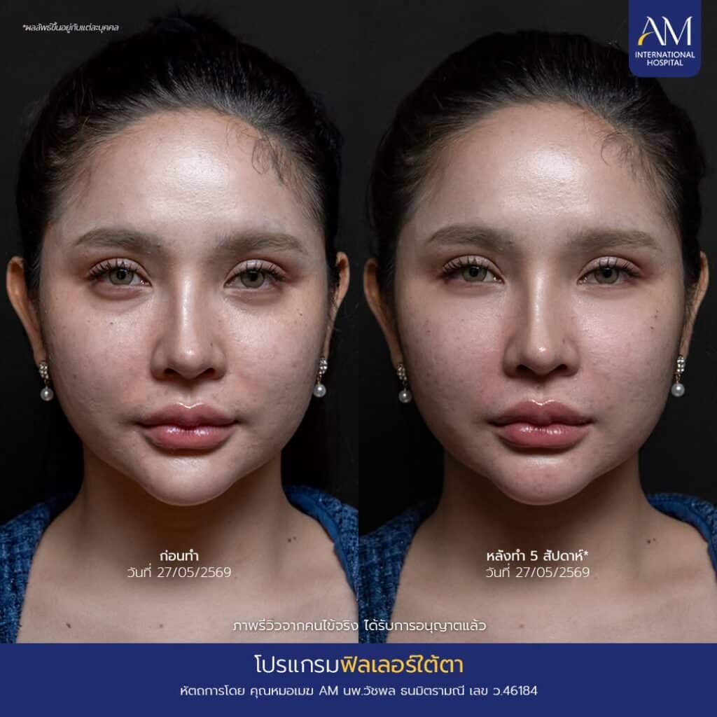 รีวิว ฟิลเลอร์ใตต้า