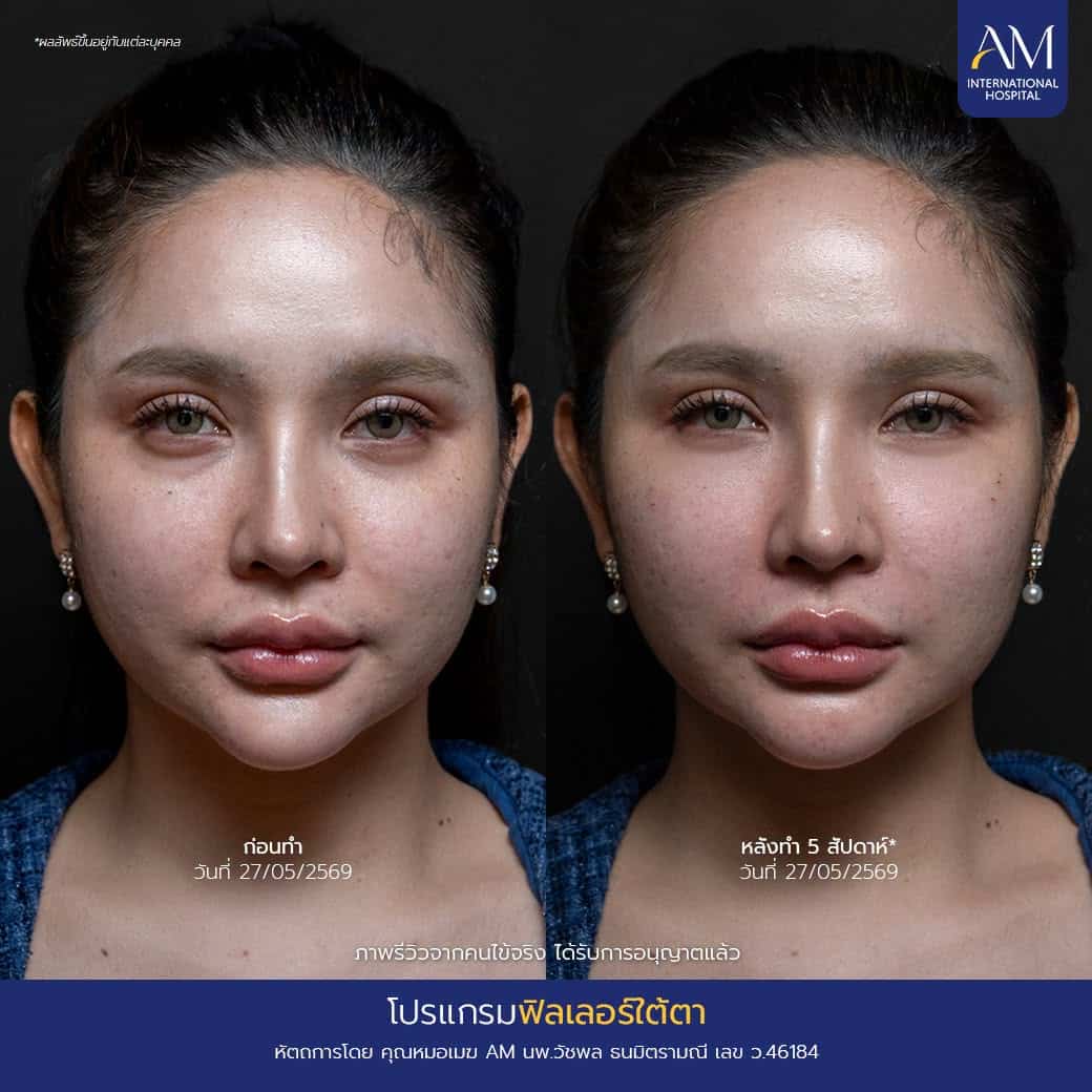 รีวิว ฟิลเลอร์ใตต้า