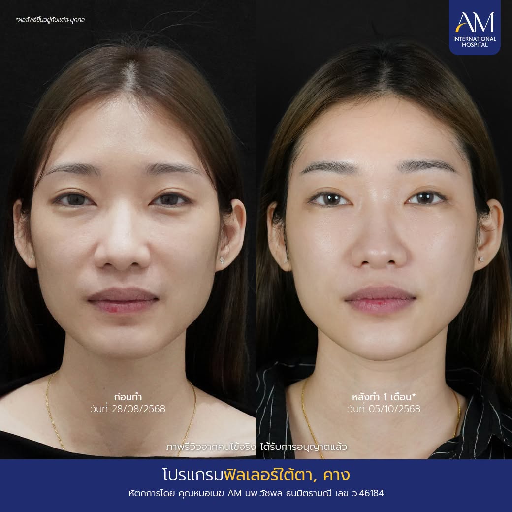 รีวิว ฟิลเลอร์ใต้ตา + ฟิลเลอร์คาง