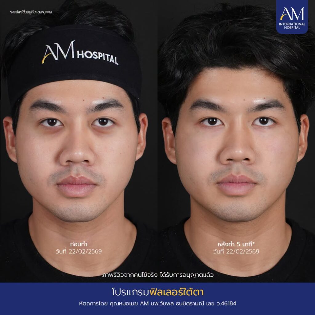 รีวิว ฟิลเลอร์ใต้ตา
