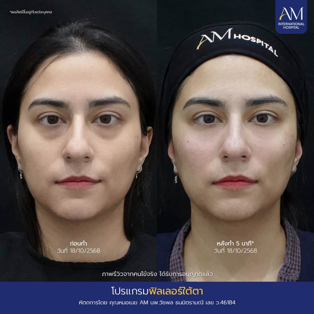 รีวิว ฟิลเลอร์ใต้ตา