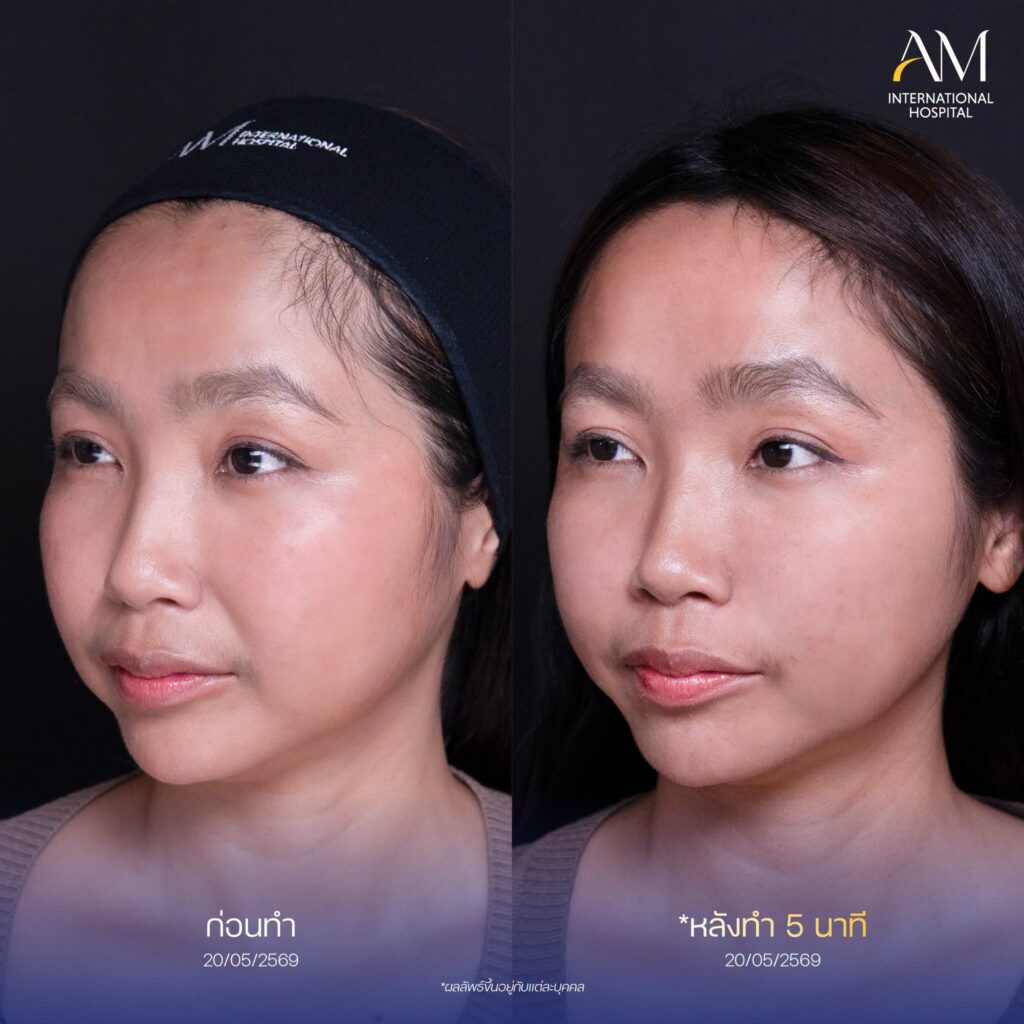รีวิว ฟิลเลอร์