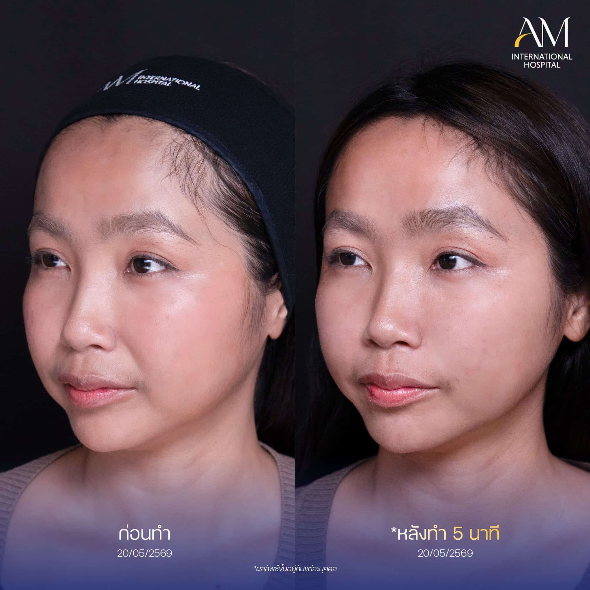 รีวิว ฟิลเลอร์