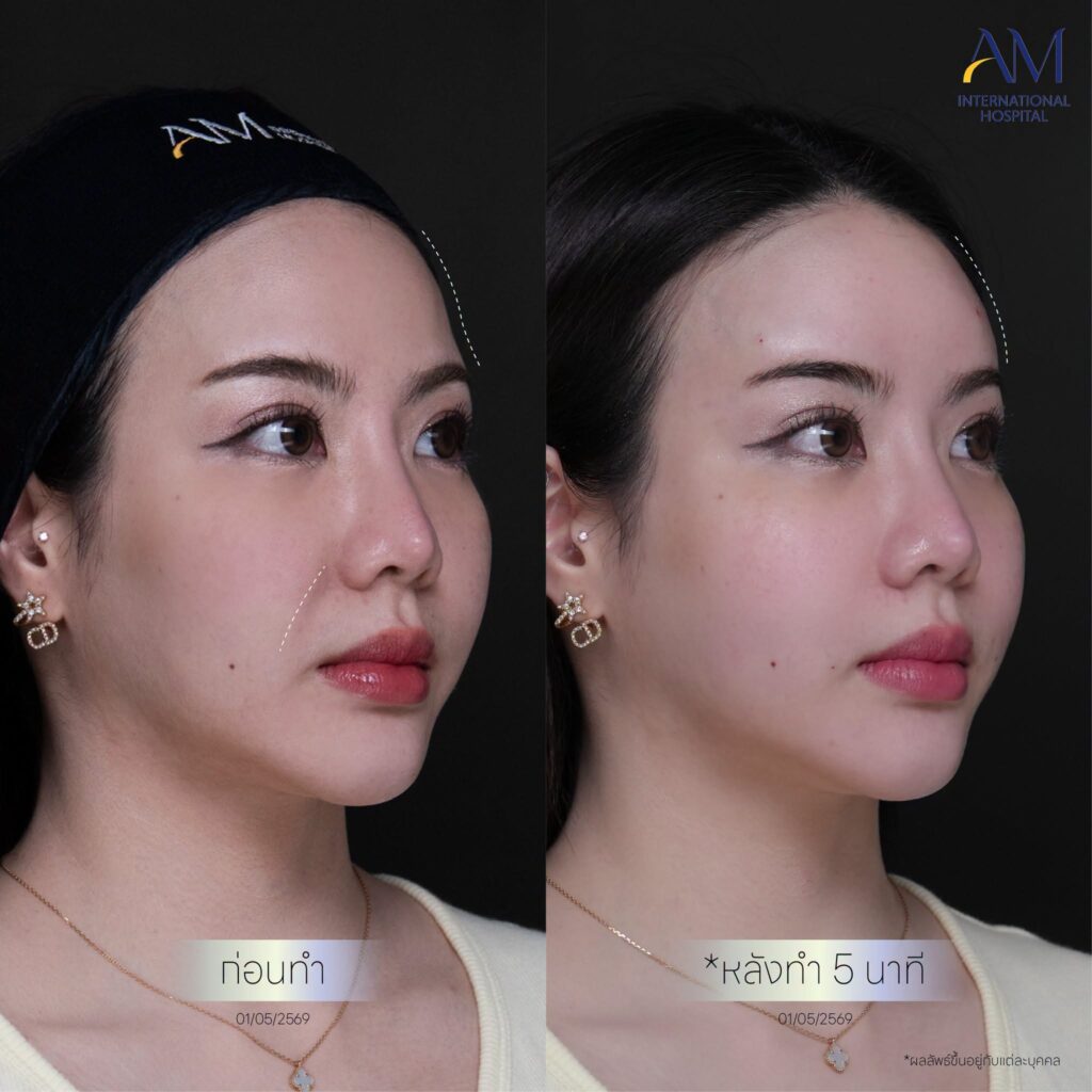 รีวิว ฟิลเลอร์