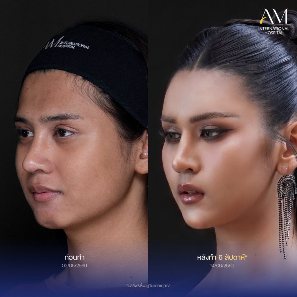 รีวิว ฟิลเลอร์