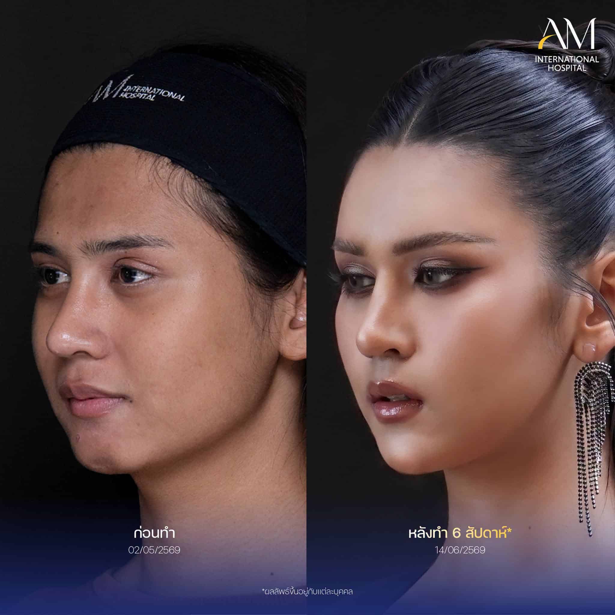 รีวิว ฟิลเลอร์