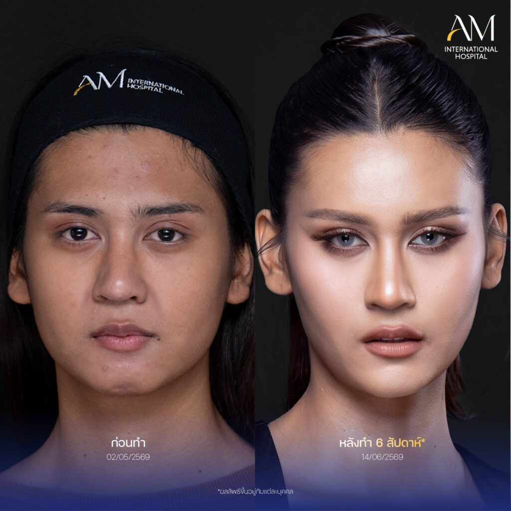 รีวิว ฟิลเลอร์