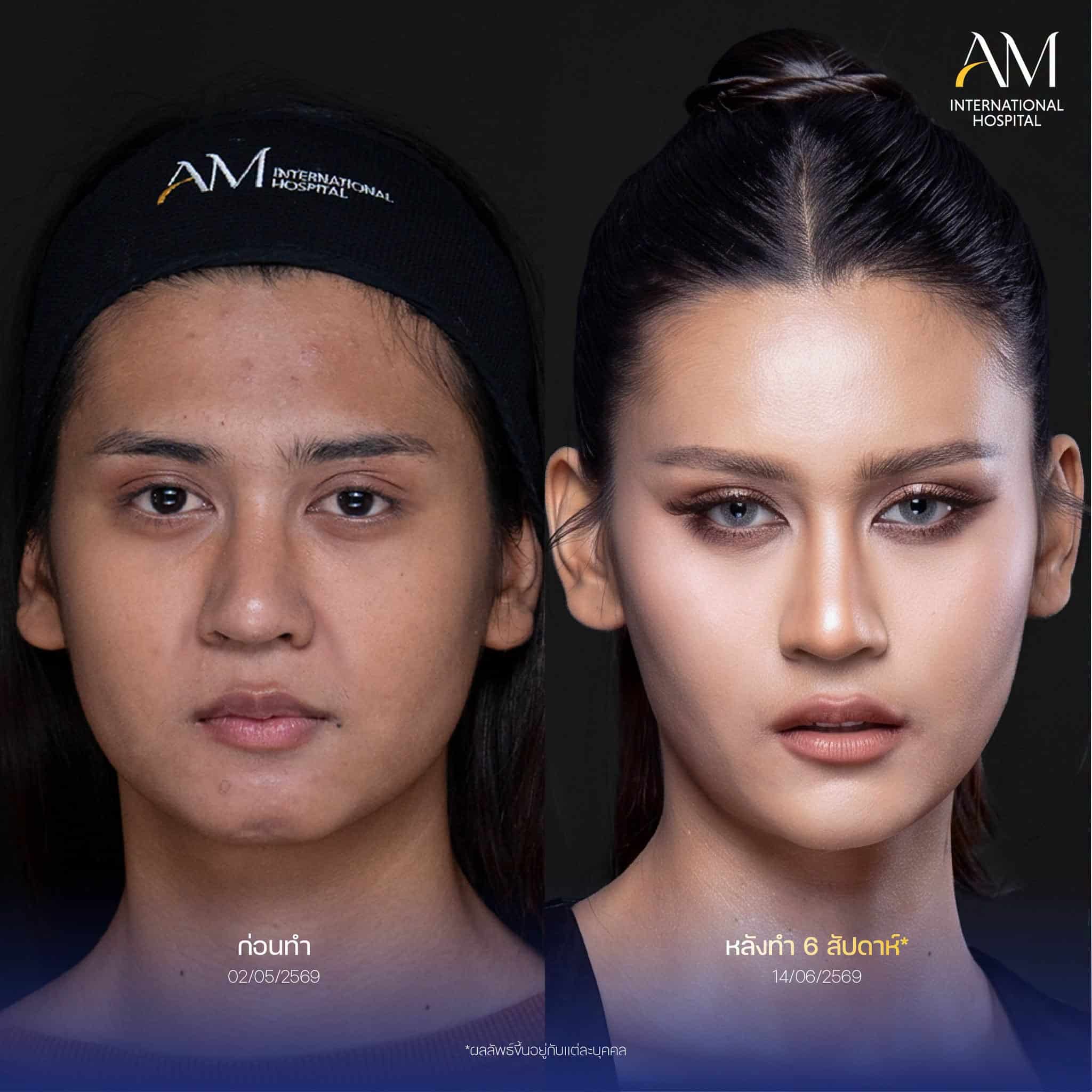 รีวิว ฟิลเลอร์