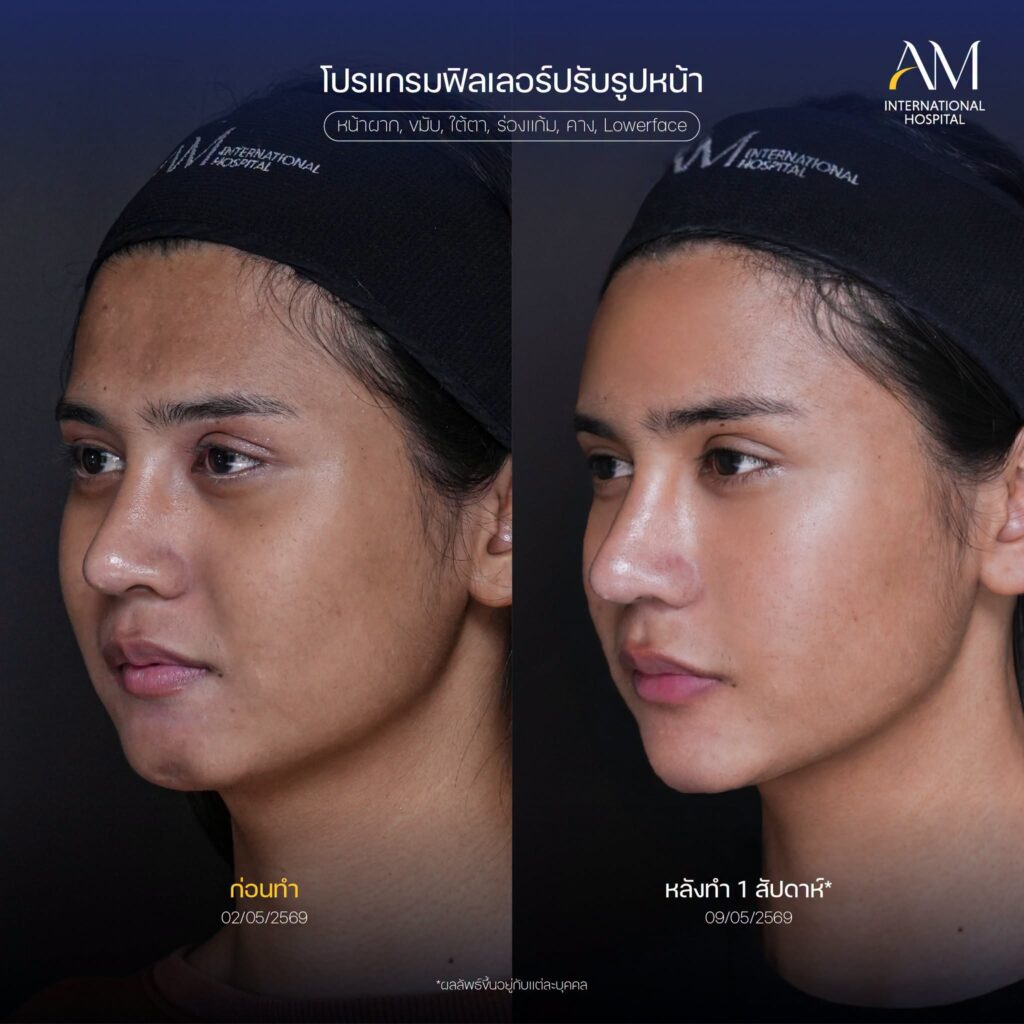 รีวิว ฟิลเลอร์ขมับ, ใต้ตา, ร่องแก้ม, คาง