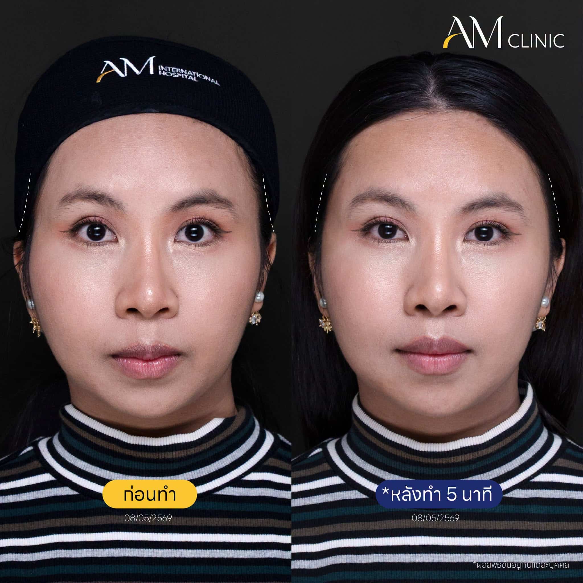รีวิว ฟิลเลอร์