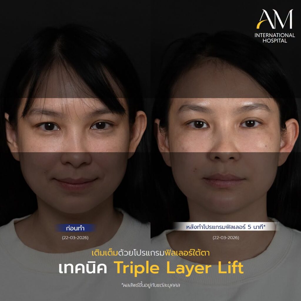 รีวิว ฟิลเลอร์ใตต้า