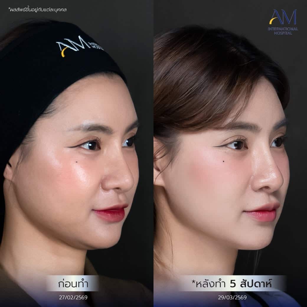 รีวิว ฟิลเลอร์