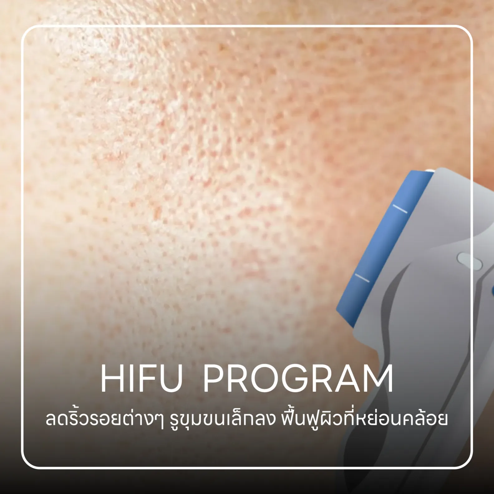 hifu โปรแกรม