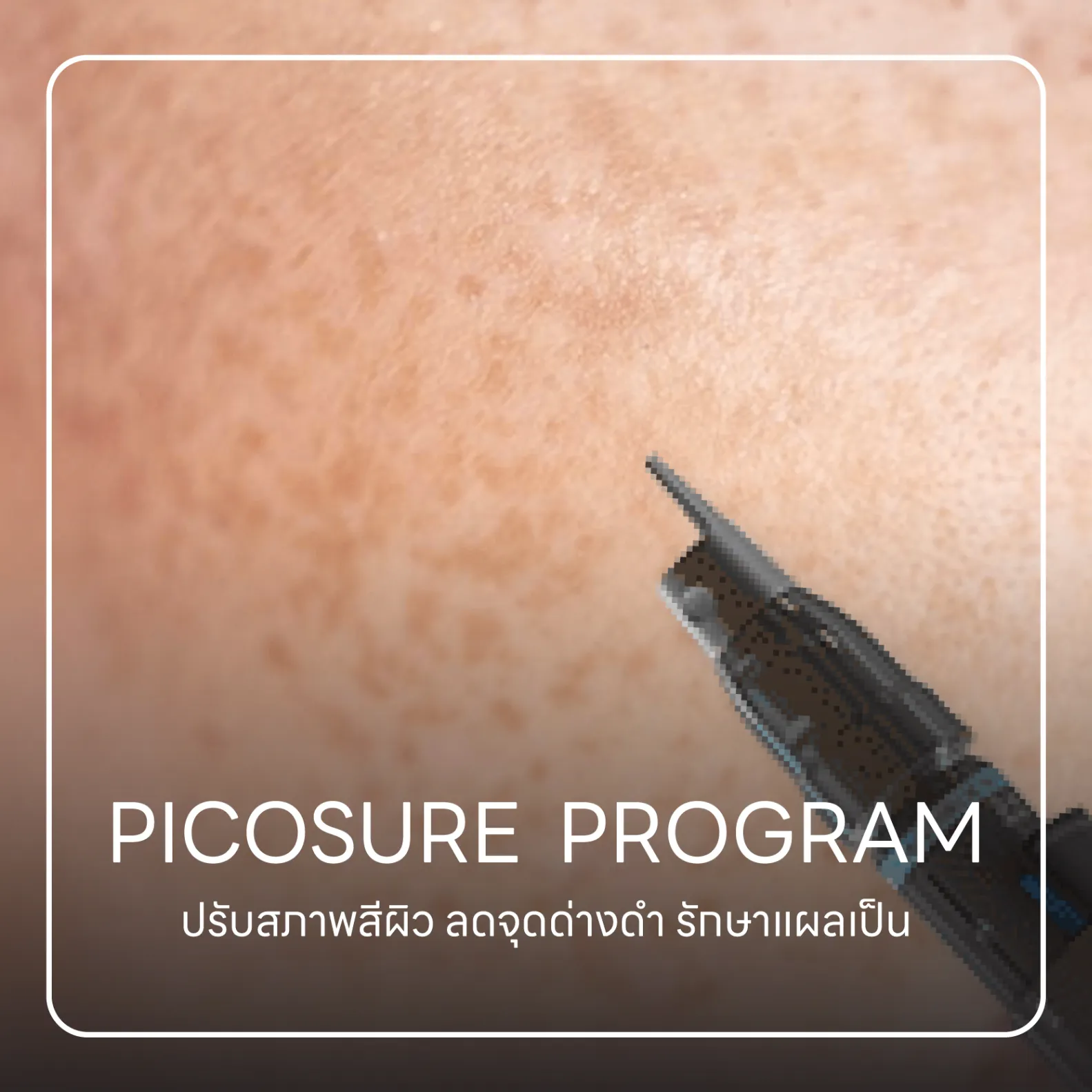 picosure โปรแกรม