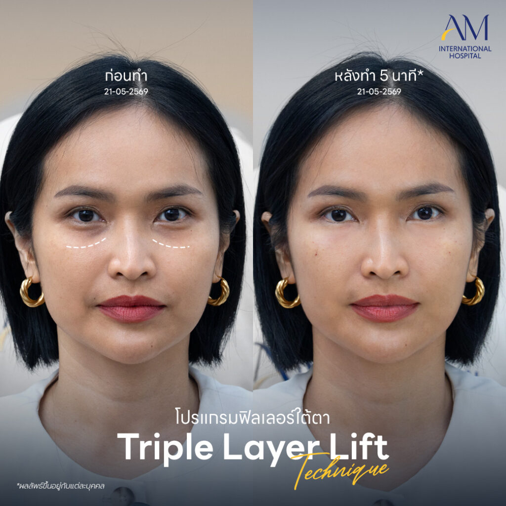 รีวิว ฟิลเลอร์