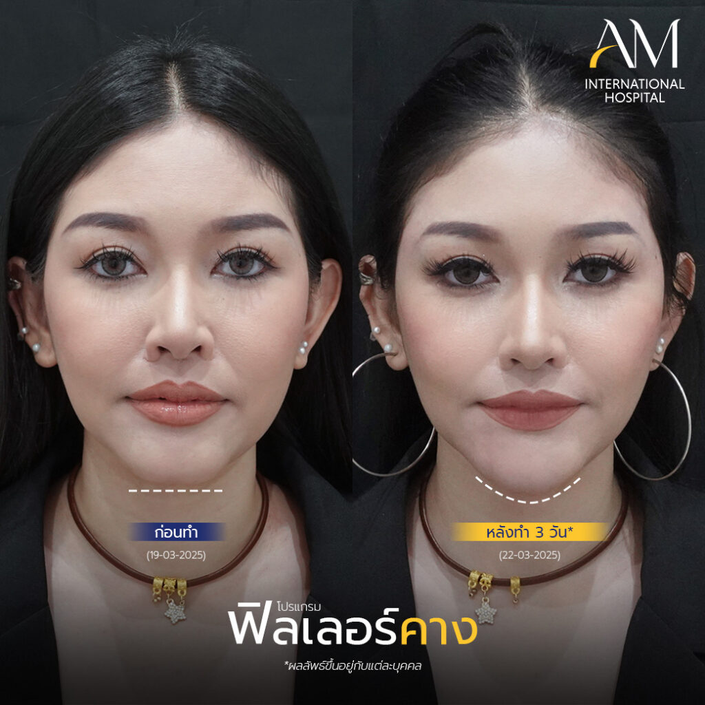 รีวิว ฟิลเลอร์