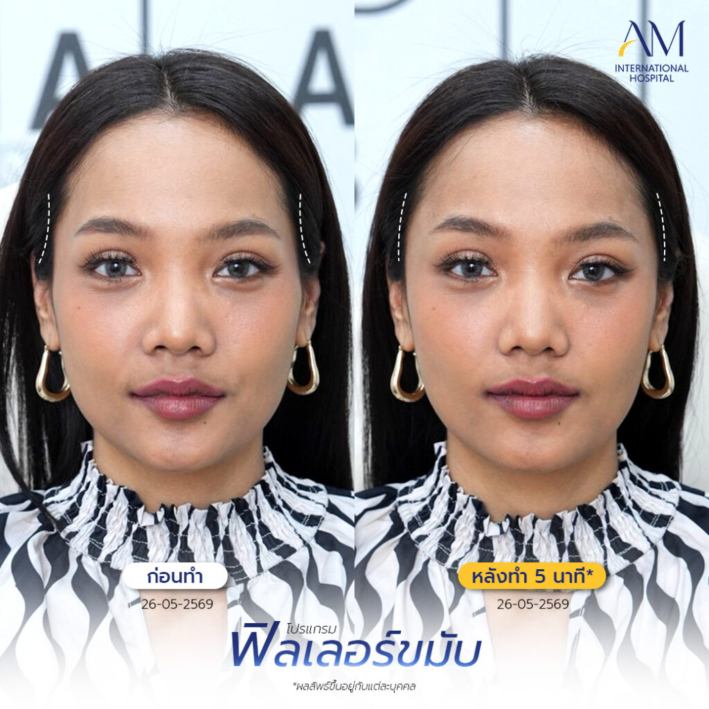 รีวิว ฟิลเลอร์