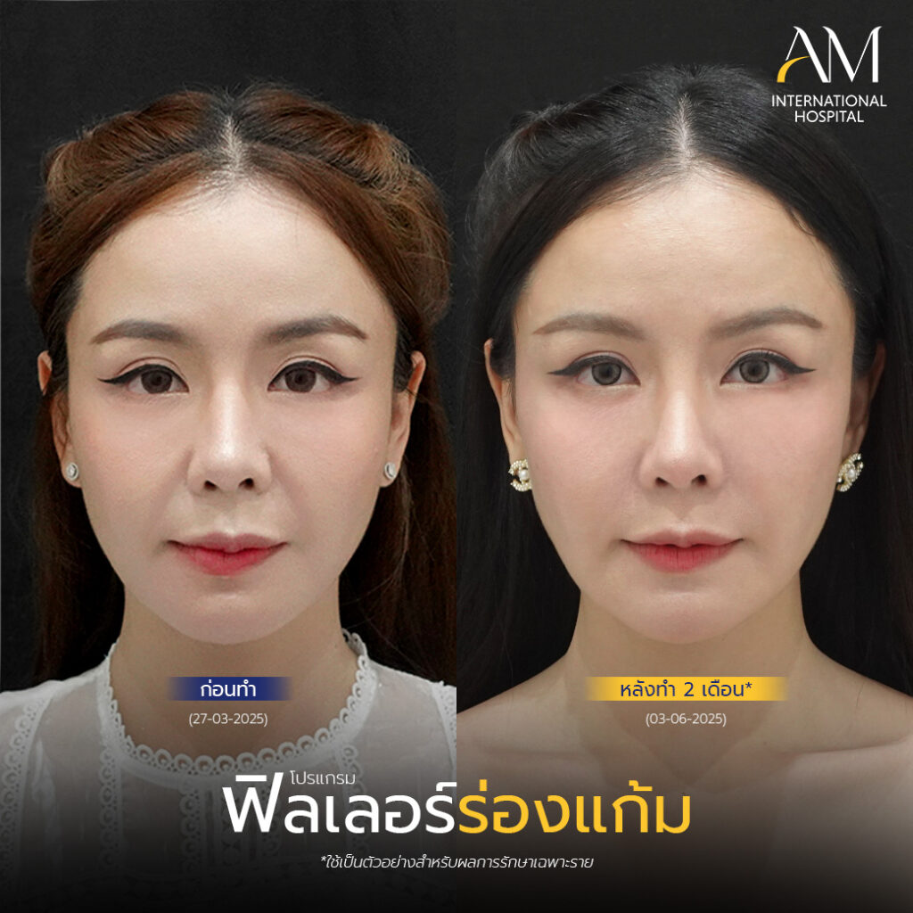 รีวิว ฟิลเลอร์