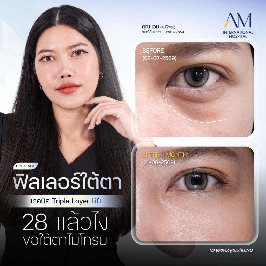 รีวิว ฟิลเลอร์