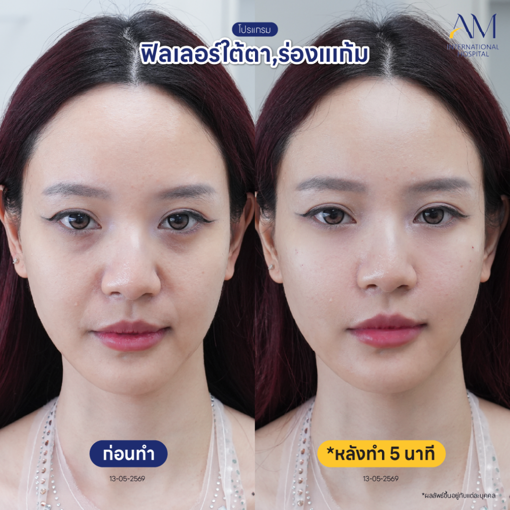 รีวิว ฟิลเลอร์