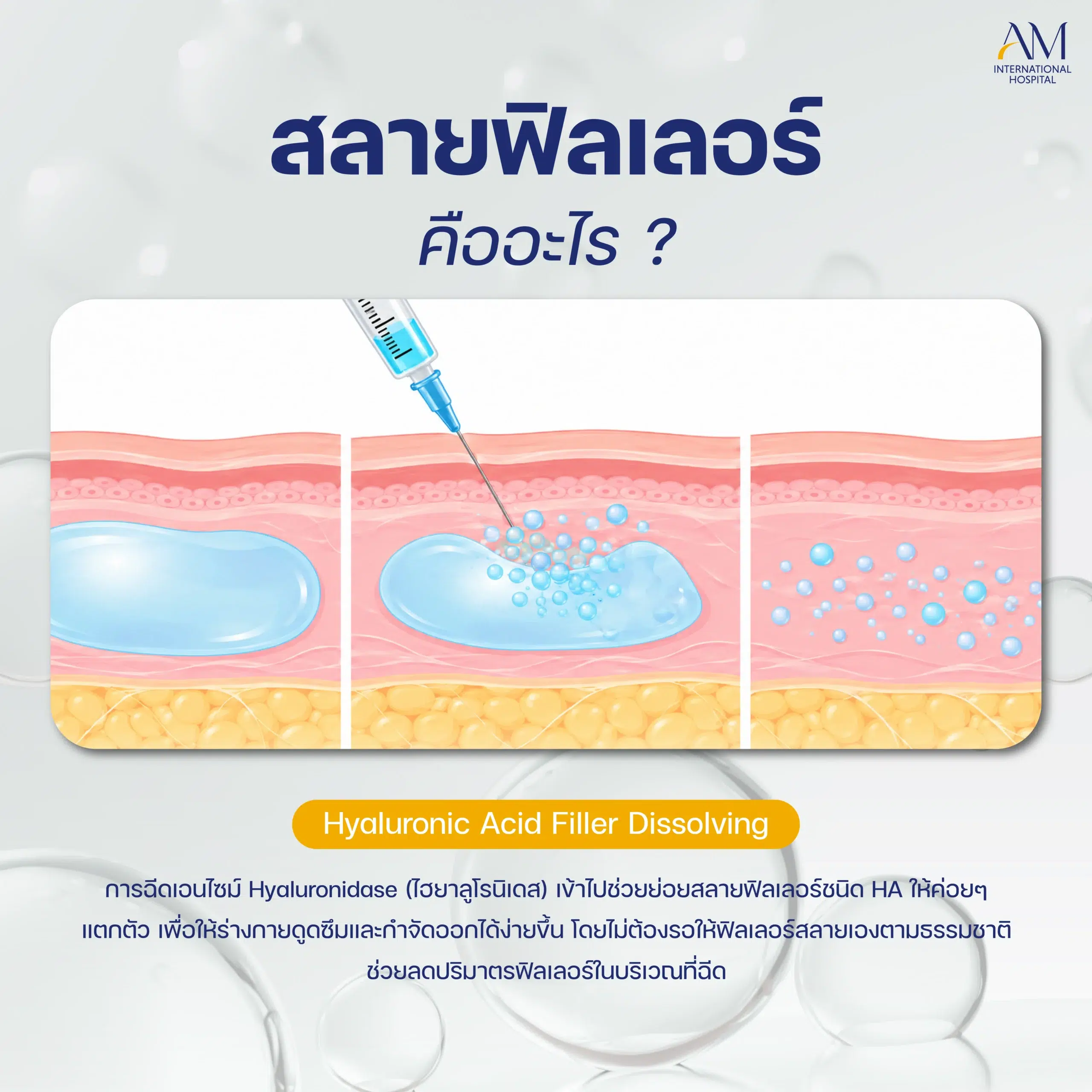 สลายฟิลเลอร์ คืออะไร